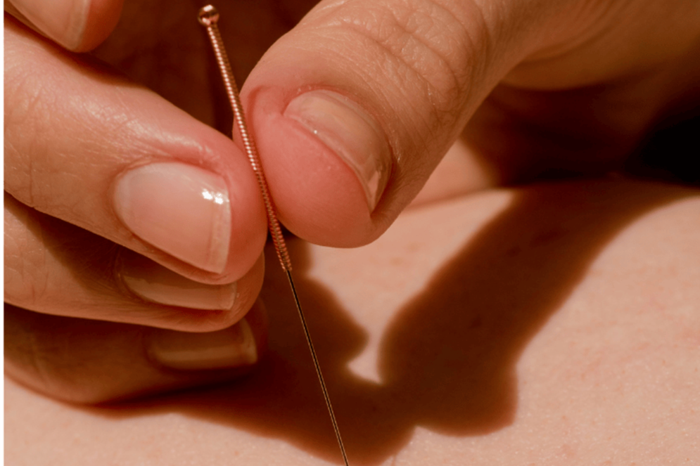 cosmetic acupuncture